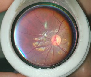 Retina image - Fundus Explorer