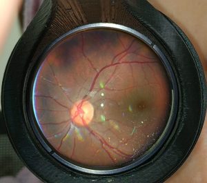 Retina image - Fundus Explorer