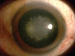 Diffuse illumination view of the left eye's double rosette cataract