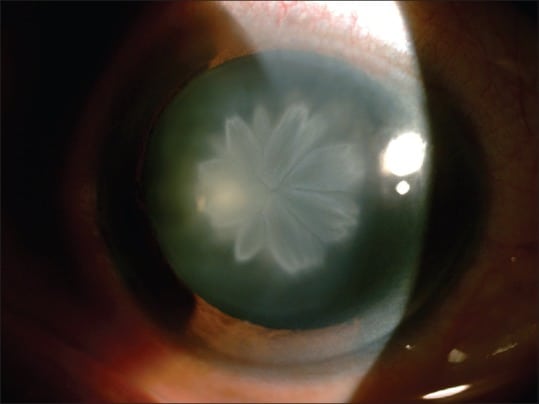 Slit lamp view of the left eye's double rosette cataract