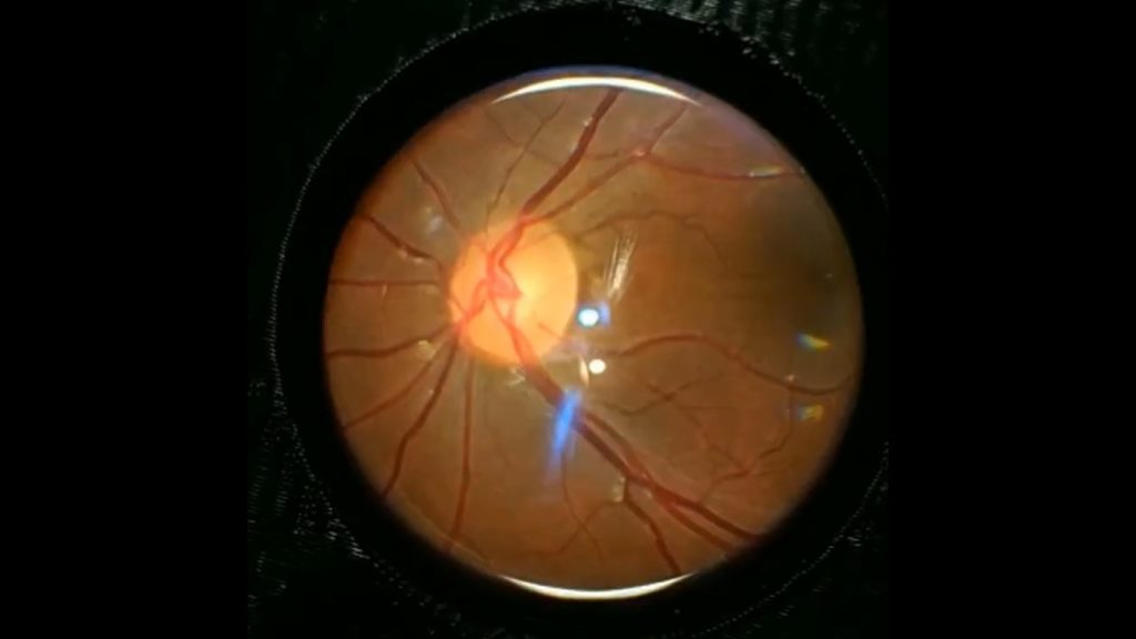 Retinal imaging by your smartphone