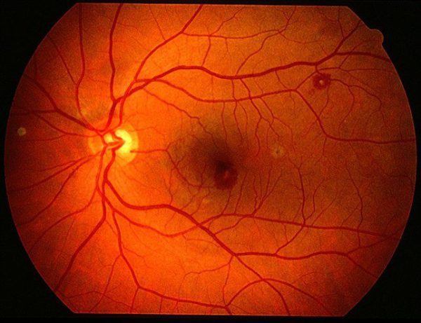 Roth Spots, Case presentation, causes, examination and