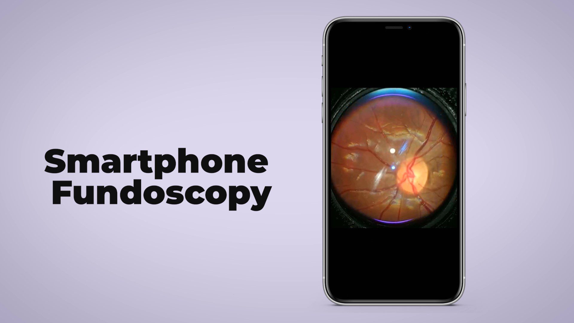 Choose the Right Smartphone Fundoscope for your Practice