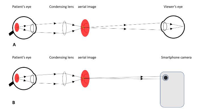 Science behind smartphone fundoscopy