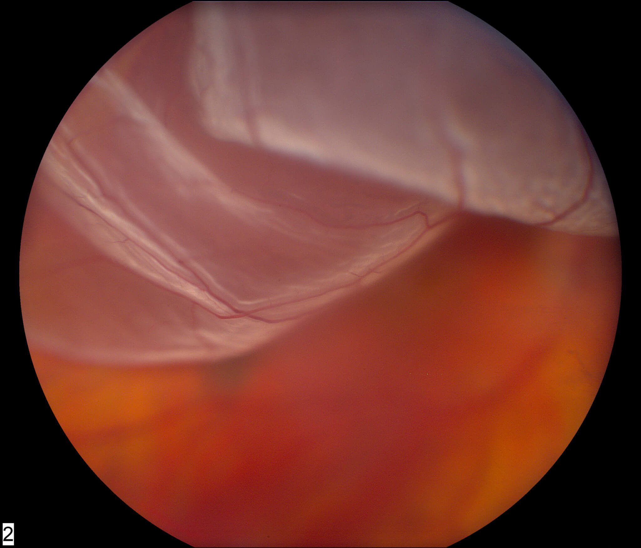 retinal detachment