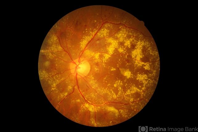 Diabetic Retinopathy