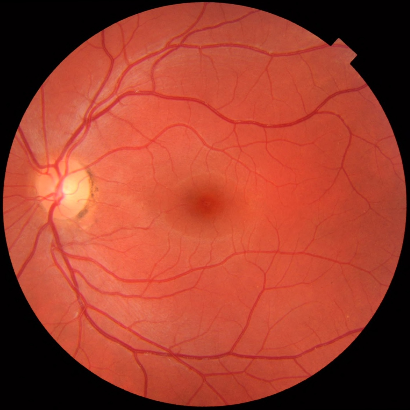 Normal fundus photograph for comparison in diabetic retinopathy screening