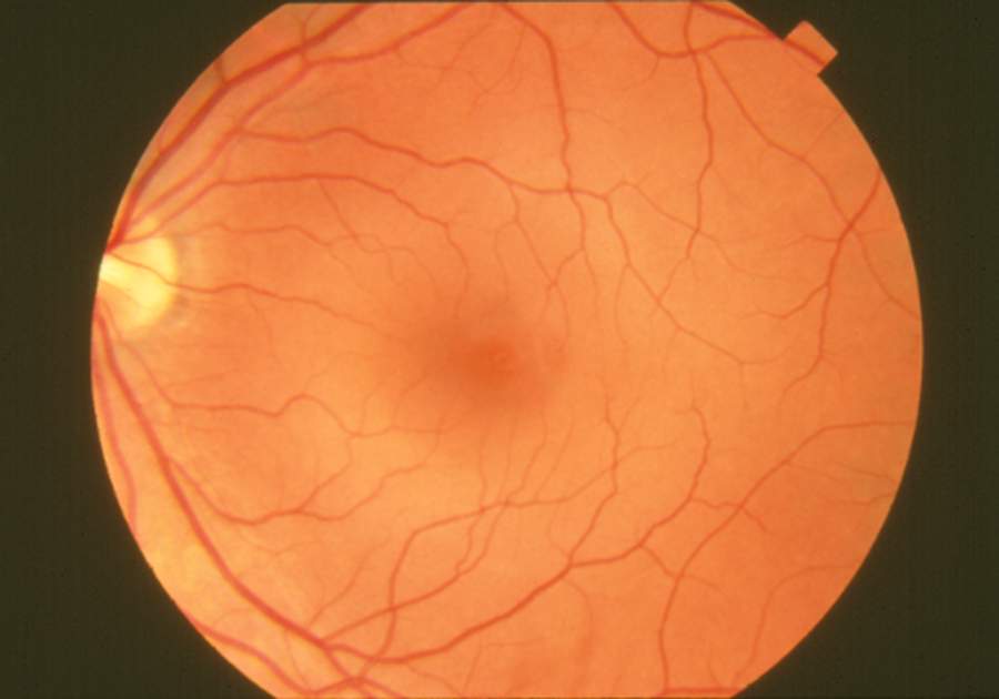 Normal retina fundus photograph from the National Eye Institute